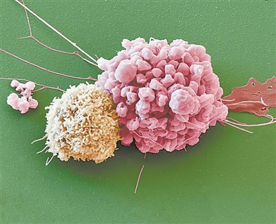 　一个免疫细胞（左）与旁边的神经系统癌细胞。图片来源：《自然》网站