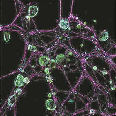 3D模型显示神经细胞（洋红色）如何与癌细胞（绿色）相互作用。图片来源：《自然》网站